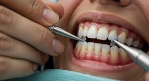 Are Veneers Permanent? Everything You Need to Know Before Getting Them