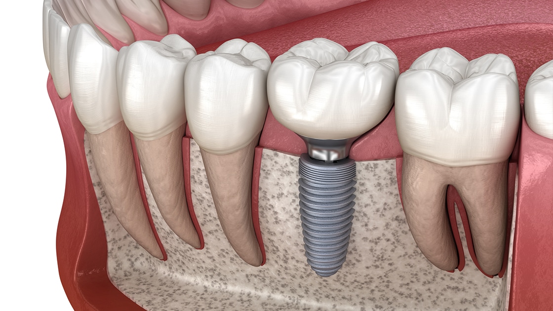 Are Dental Implants Really Worth It? 7 Things to Know Before Choosing