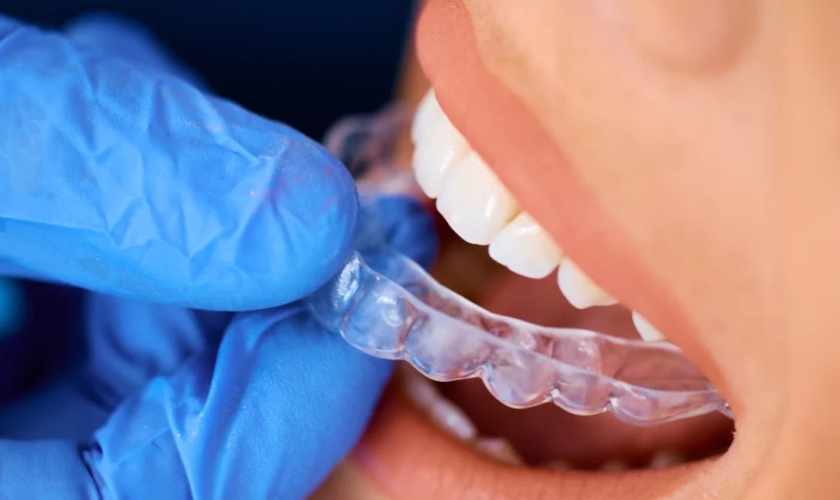 How Much Does Invisalign Really Cost? A Breakdown for Patients
