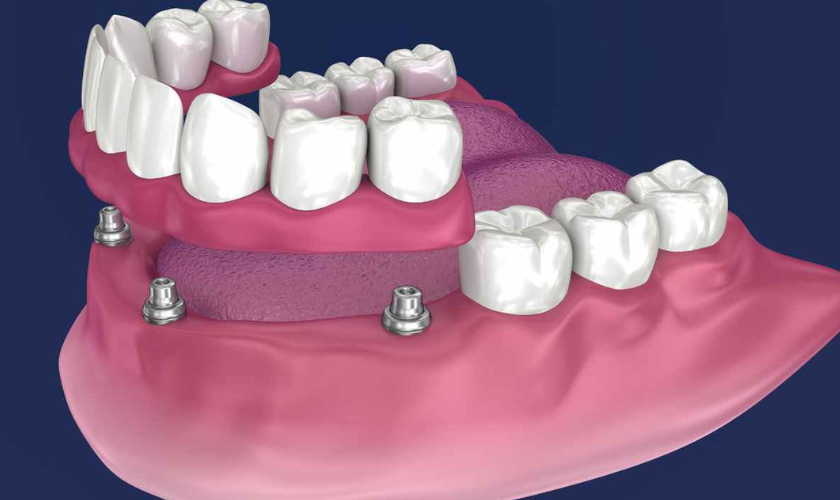 Why Dental Implants Are Becoming the Go-To Solution for Dubai Residents