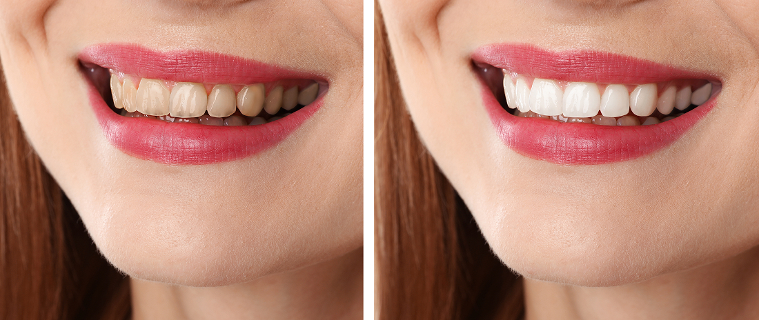 The Real Difference Between Premium & Cheap Veneers in Dubai