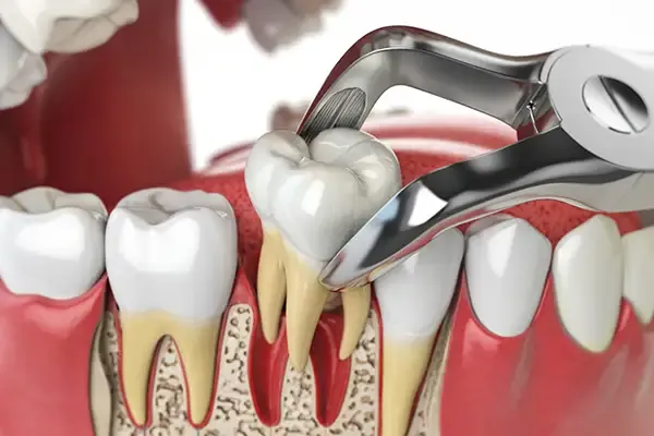 Tooth Extraction: What to Expect Before, During & After