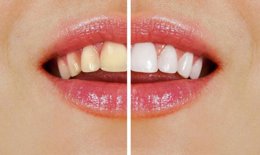Teeth Whitening: Professional vs At-Home Kits – Which One Wins?