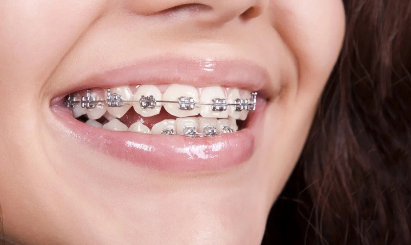 The Most Common Myths About Braces & Invisalign – Busted!