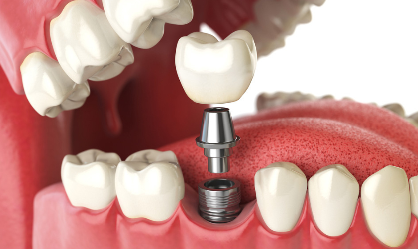 Understanding Dental Implants and Their Longevity