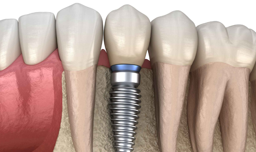 Dentures vs Implants: Which Is the Right Choice for You?