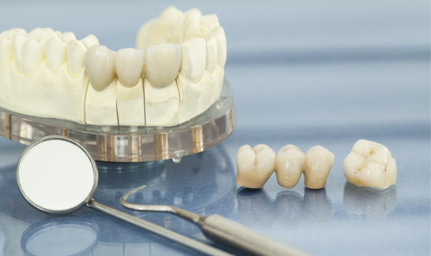 Crowns & Bridges Explained: Cost, Benefits, and Longevity