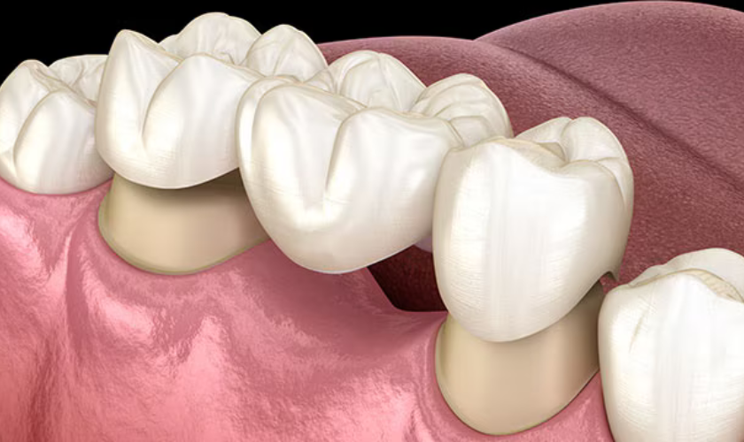 Introduction to Dental Crowns and Bridges