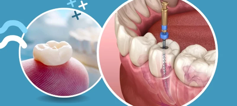 Crown-and-root-canal Crown-and-root-canal