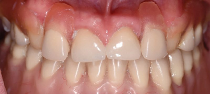 Prosthodontic Rehabilitation Prosthodontic Rehabilitation