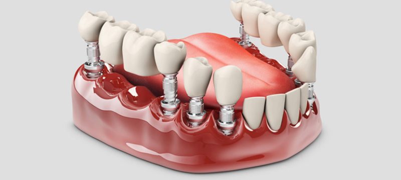 difference-between-crown-and-bridge-procedures difference-between-crown-and-bridge-procedures
