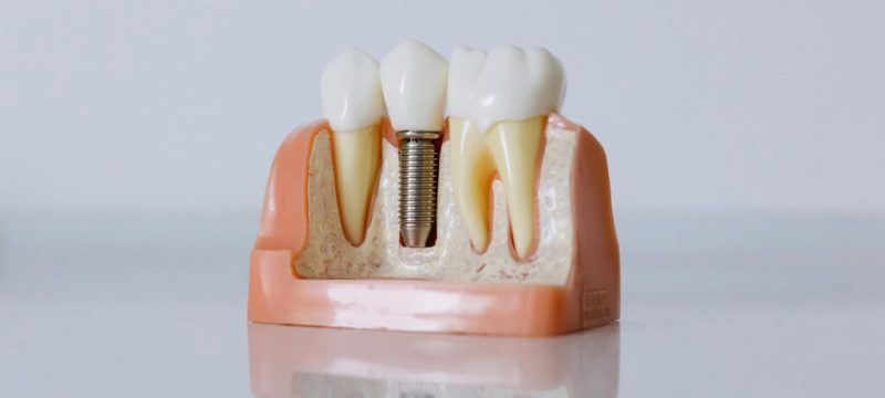 implantologia__1-1024×576 implantologia__1-1024x576