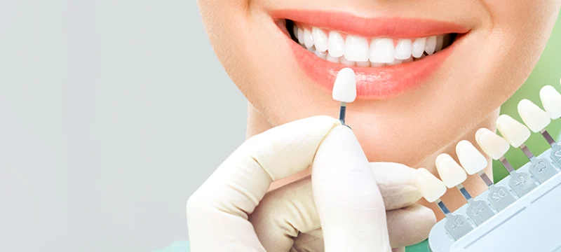 veneers veneers